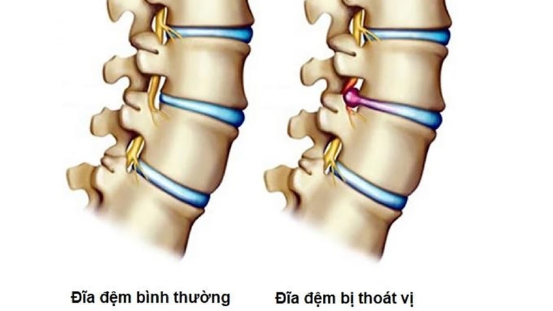 Những điều cần biết về bệnh rễ thần kinh 5