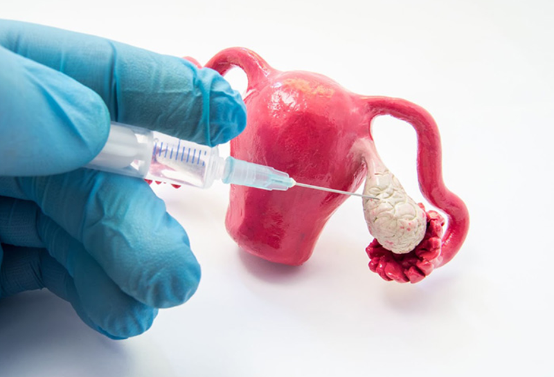 Bách khoa toàn thư giải đáp mọi thắc mắc về tiêm thuốc kích trứng 1