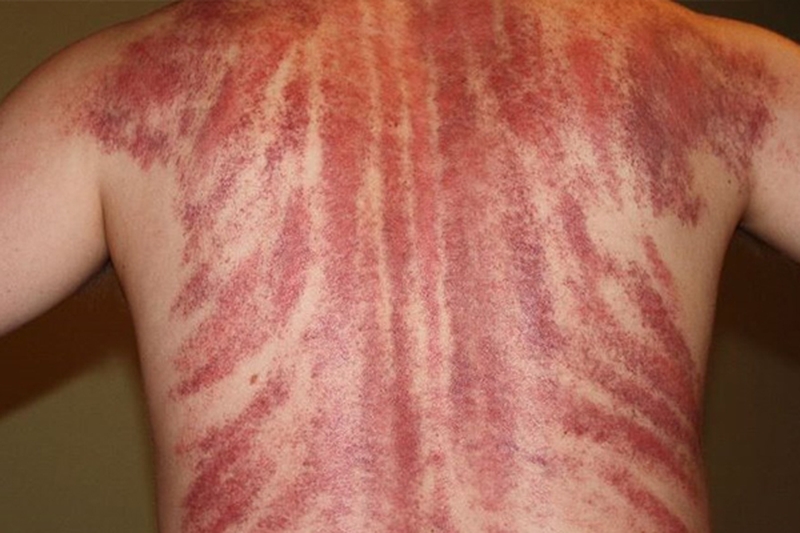 Bài thuốc hay: Cách đánh cảm bằng lá ngải cứu 1