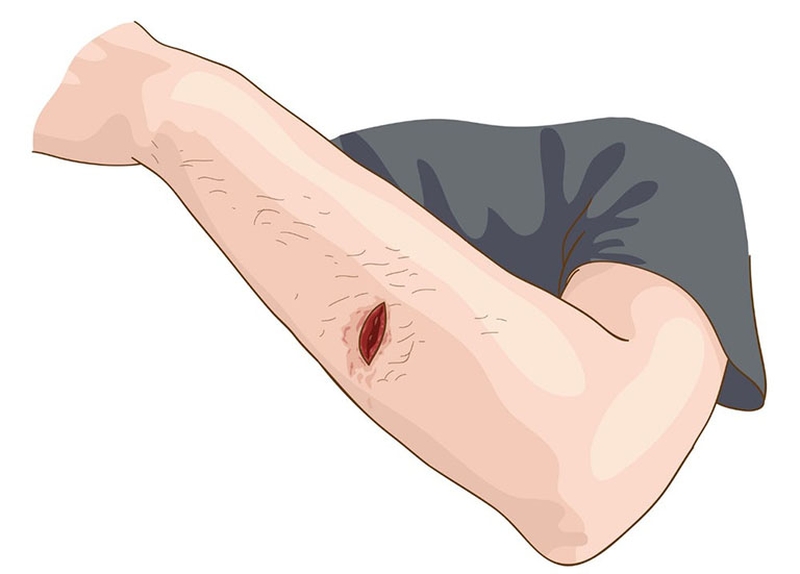 Cách sử dụng khăn ướt đúng: không lau vết thương hở