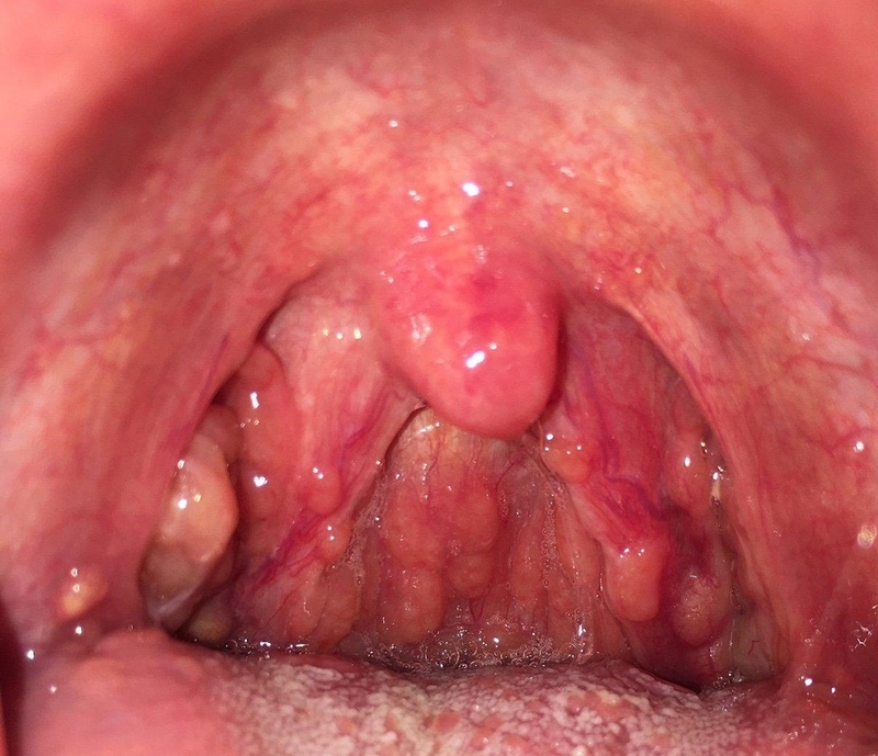 Bật mí mẹo chữa vướng cổ họng đơn giản và hiệu quả không phải ai cũng biết 1