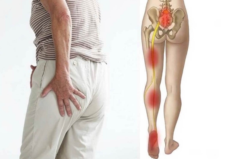 Bật mí một số cây thuốc nam giúp bạn chữa đau dây thần kinh tọa 5