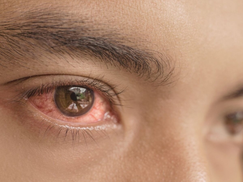 Bật mí một vài cách giảm đau mắt đỏ sưng húp hiệu quả 2