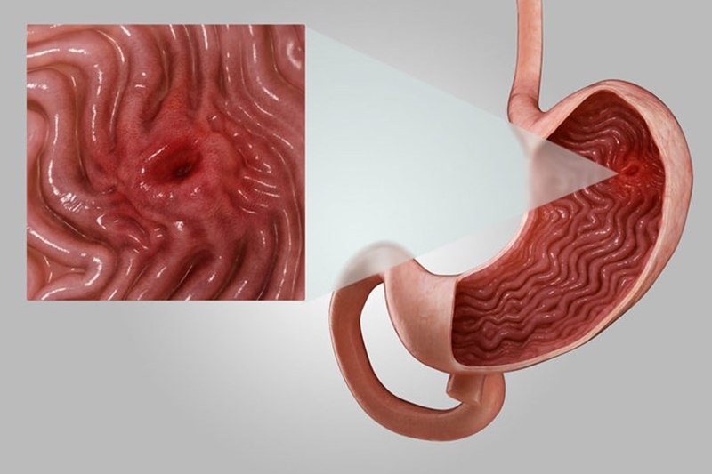 Bật mí nên ăn gì để giảm tiết axit dạ dày hiệu quả 3