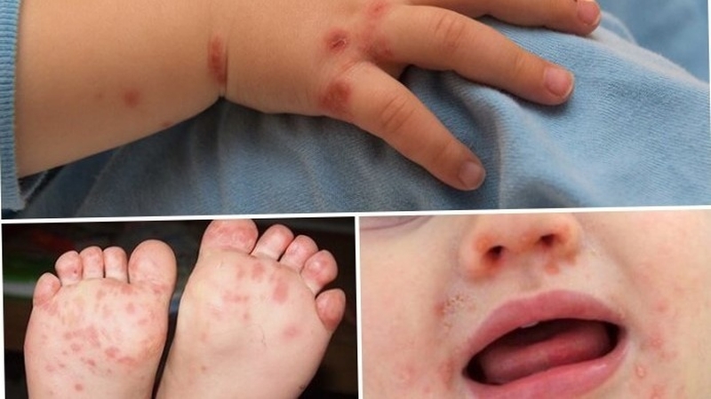 Bệnh chân tay miệng cấp độ 1có nguy hiểm không 3