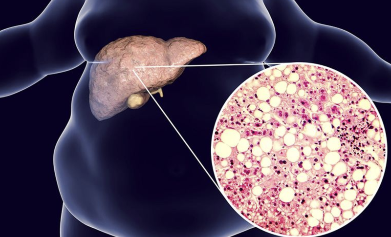 benh-gan-co-lay-khong-cac-van-de-lien-quan-den-gan 3