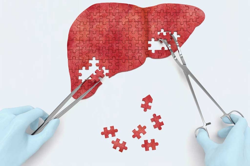 Bệnh gan nhiễm mỡ và các cách chữa bệnh gan nhiễm mỡ bằng nghệ an toàn tại nhà 1