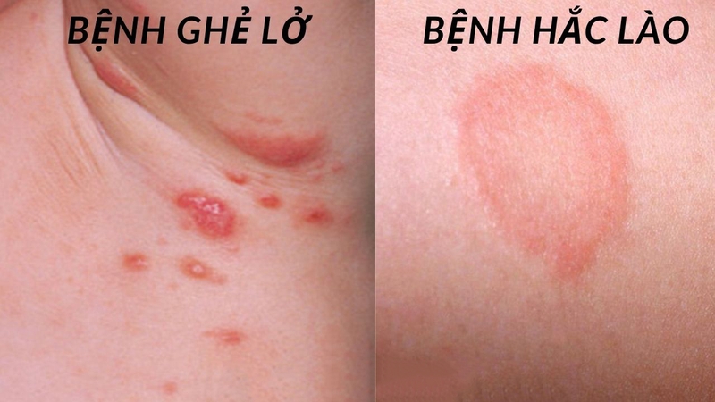 Bệnh ghẻ lở hắc lào là gì? Cách phân biệt ghẻ lở và hắc lào 1