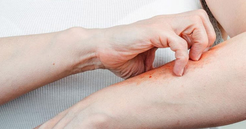 Ghẻ nước là bệnh gì? Bệnh ghẻ nước có lây không 2