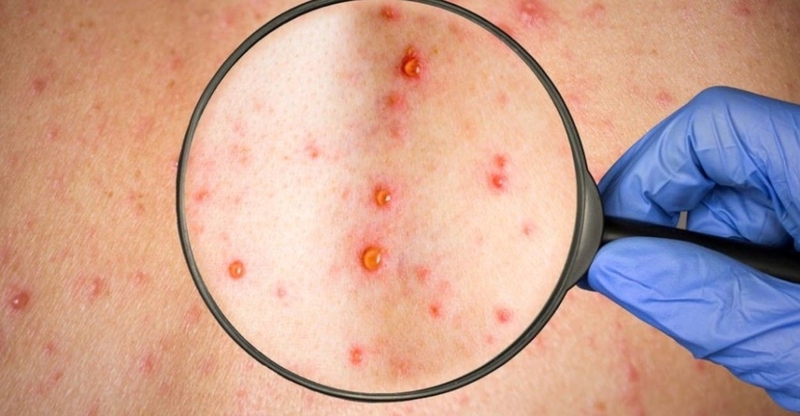 Bệnh giang mai có ngứa không? Cách phòng tránh bệnh giang mai hiệu quả mà bạn nên biết 2