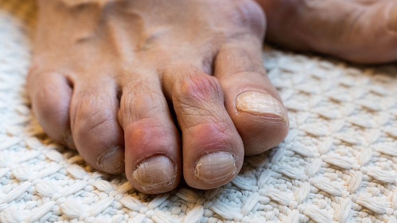 Bệnh gout có trị dứt điểm được không? Những lưu ý cần biết về bệnh gout 2