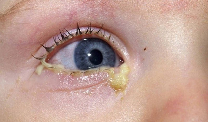 Bệnh lậu lây qua những đường nào? Bệnh lậu có lây qua quần áo không? 4