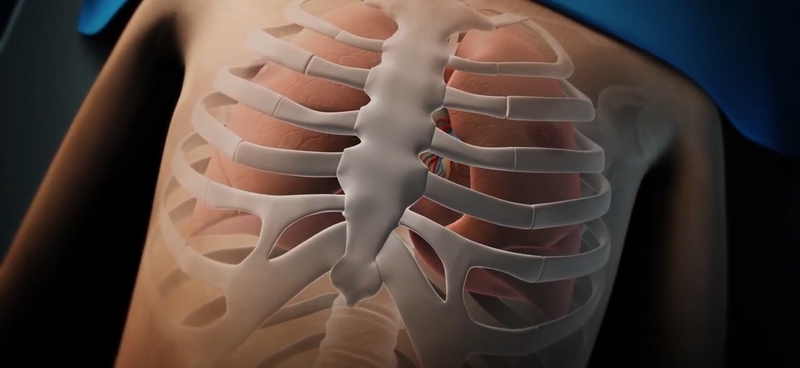 Bệnh lõm xương ức ở người lớn: Những hệ lụy về sức khỏe 1