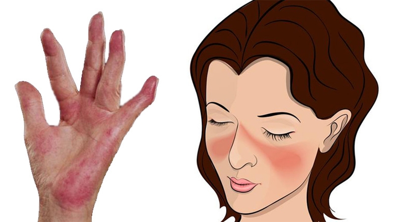 Gợi ý cho bạn một số thuốc bôi lupus ban đỏ dạng đĩa hiệu quả 1