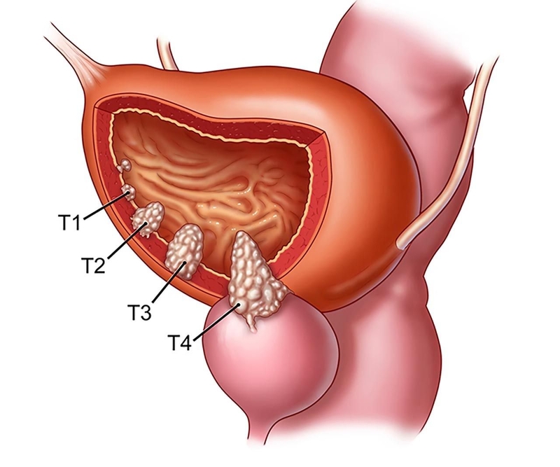 Bệnh nhân ung thư bàng quang sống được bao lâu? Lưu ý khi chăm sóc bệnh nhân ung thư  2
