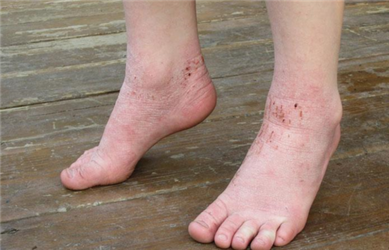 Chàm tổ đỉa có bị lây từ người sang người không? 2