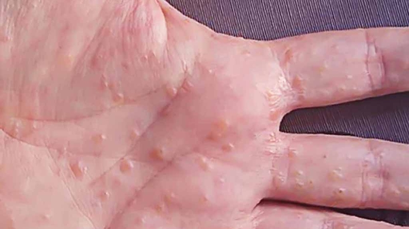 Bệnh tổ đỉa có chữa được không? 1