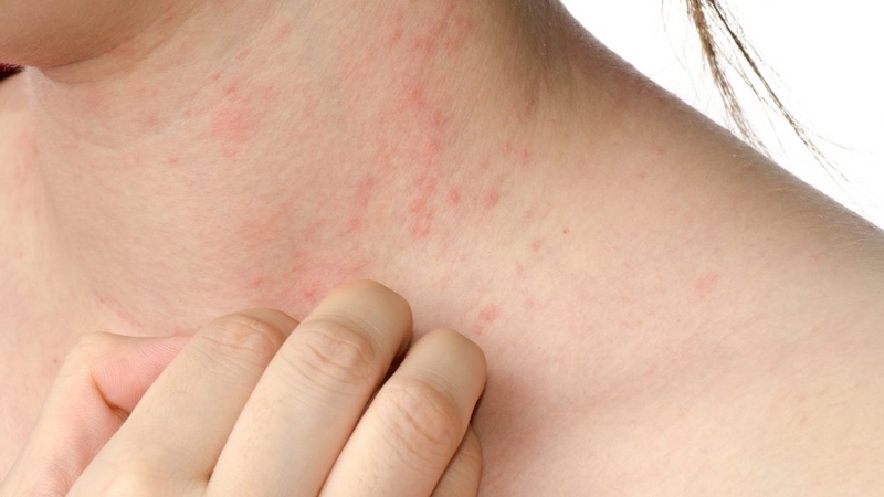 Bệnh tổ đỉa có chữa được không? 3