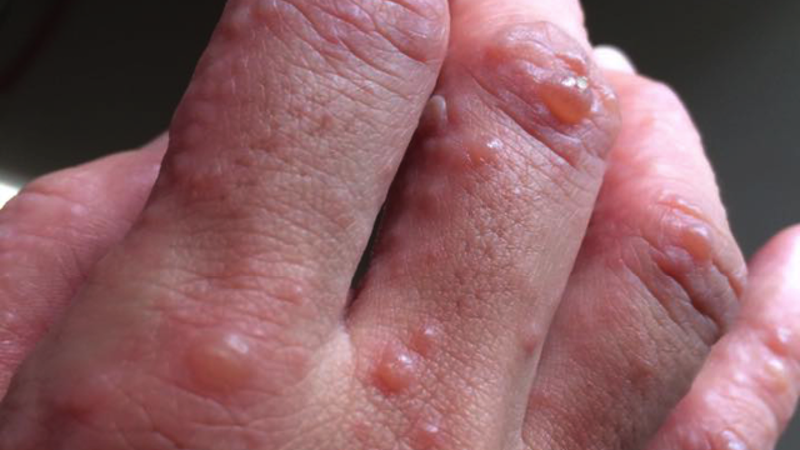 Bệnh tổ đỉa thường không mang tính chất di truyền