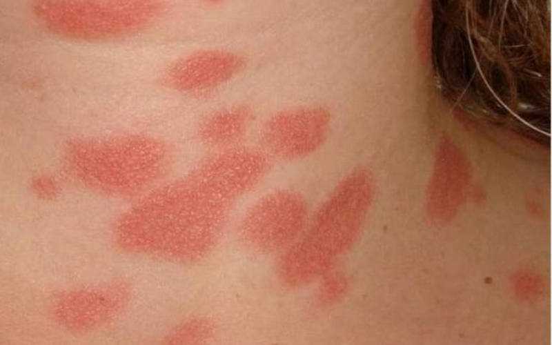 Benh-vay-nen-hong-co-lay-khong (2).png