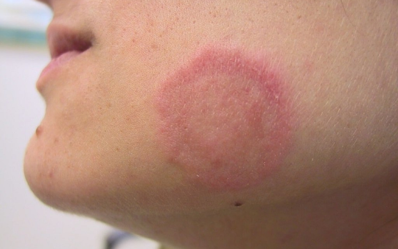 Benh-vay-nen-hong-co-lay-khong (3).png