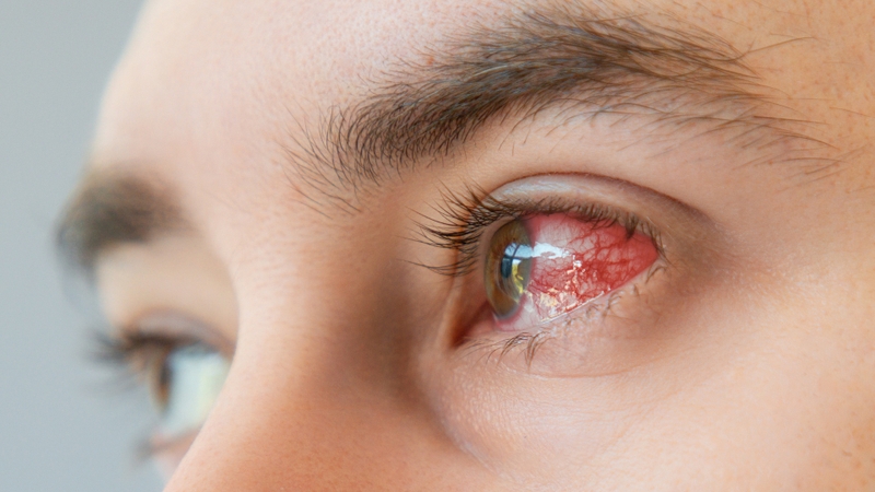 Điểm mặt 4 bệnh về mắt mùa hè phổ biến và cách phòng tránh hiệu quả 1