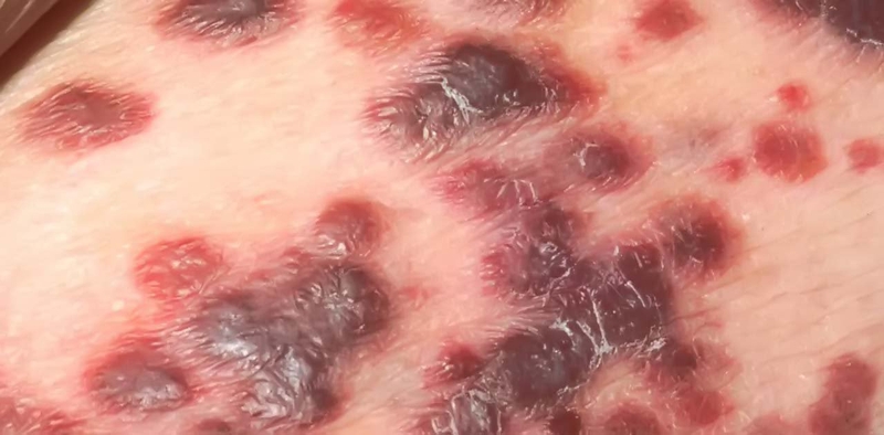 Bệnh xã hội HIV là gì? Người nhiễm HIV vết thương có lành không? 4