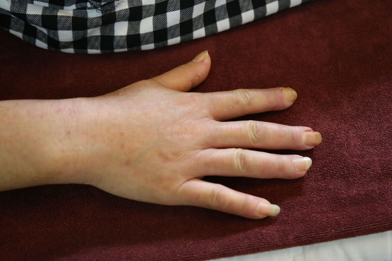 Xơ cứng bì là gì? Bệnh xơ cứng bì sống được bao lâu 1