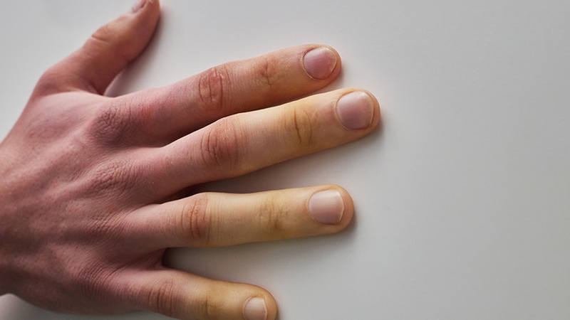 Xơ cứng bì là gì? Bệnh xơ cứng bì sống được bao lâu 2