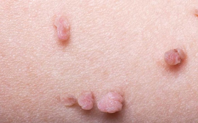 Bị nhiễm hpv 16 có thai được không? Ảnh hưởng gì đến thai kỳ và sau sinh? 1