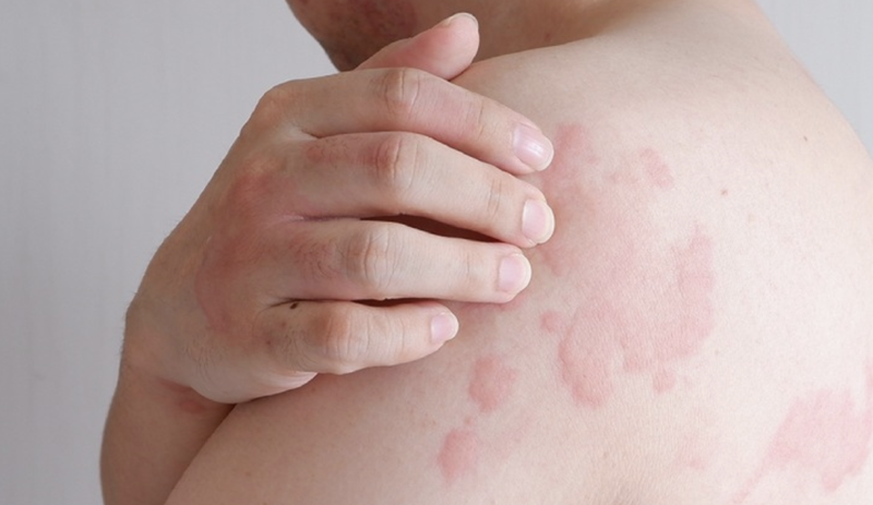 bi-phong-ngua-va-nhung-dieu-can-biet 1