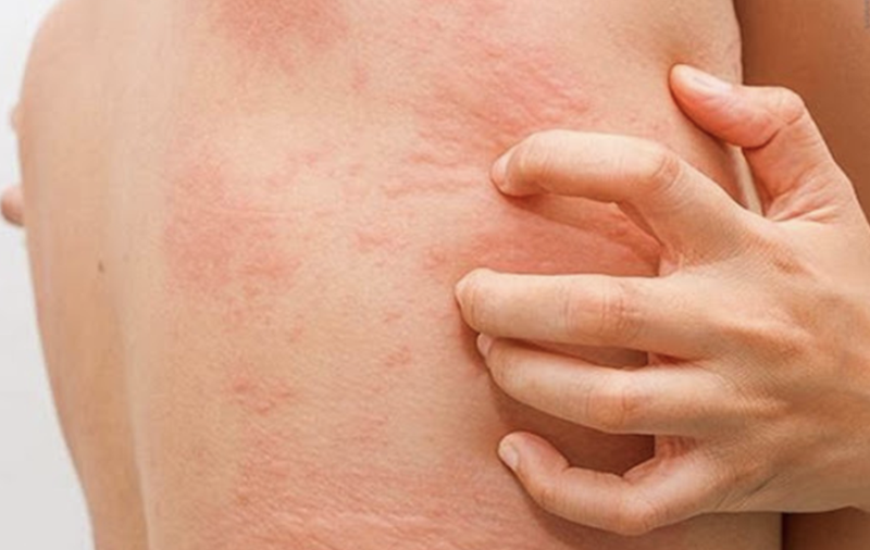 bi-phong-ngua-va-nhung-dieu-can-biet 2