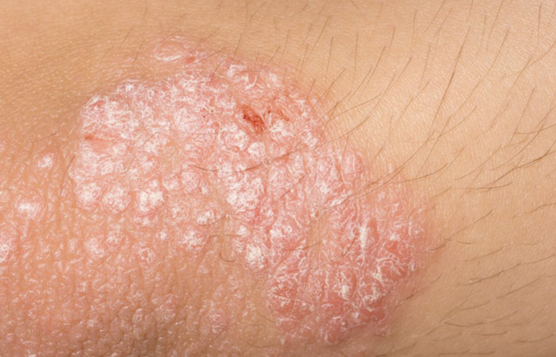 bi-phong-ngua-va-nhung-dieu-can-biet 3