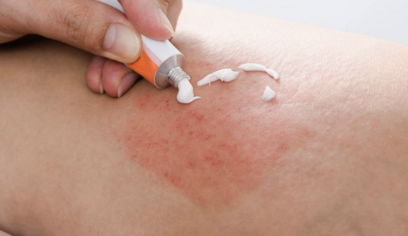 bi-phong-ngua-va-nhung-dieu-can-biet 4