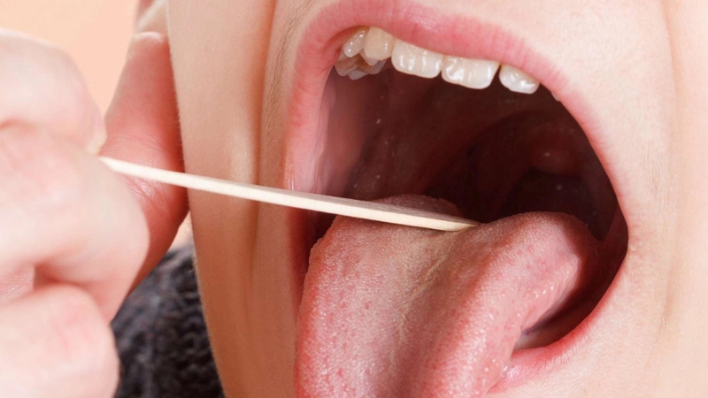 Tìm hiểu về bị sùi mào gà ở lưỡi chữa thế nào? 2