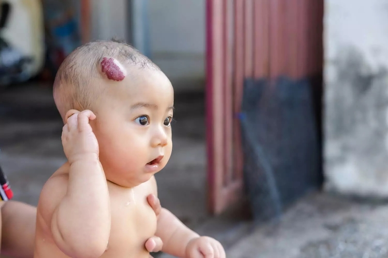 Bướu mạch máu là gì? Nguyên nhân, triệu chứng và phương pháp điều trị 7