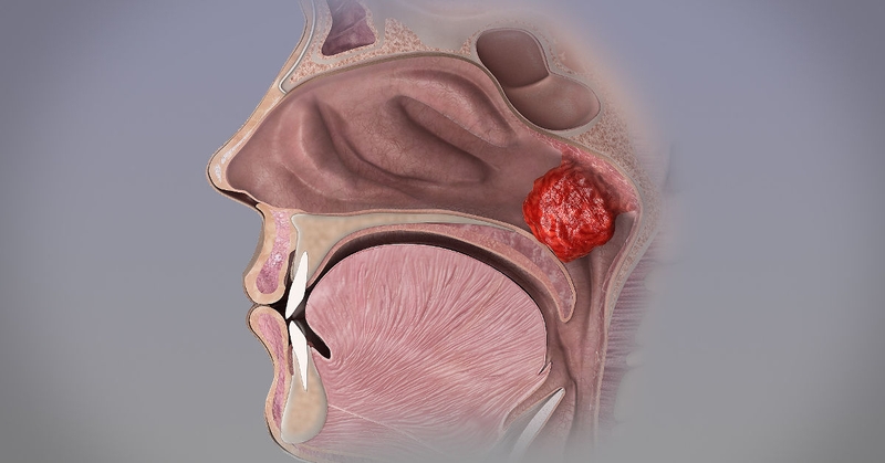 Các bệnh lý dễ nhầm lẫn với viêm VA ở trẻ nhỏ 1.jpg