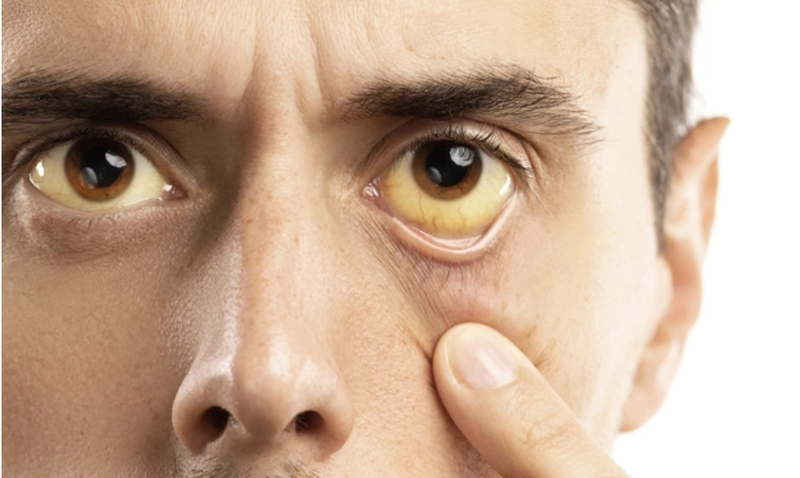 cac-dau-hieu-gan-khong-tot-va-cach-phong-ngua 2