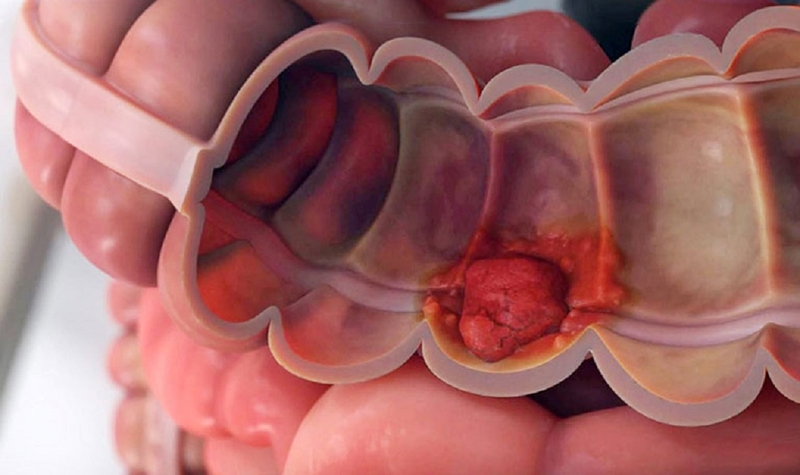 Các phương pháp chẩn đoán và điều trị ung thư đại tràng giai đoạn 3 1