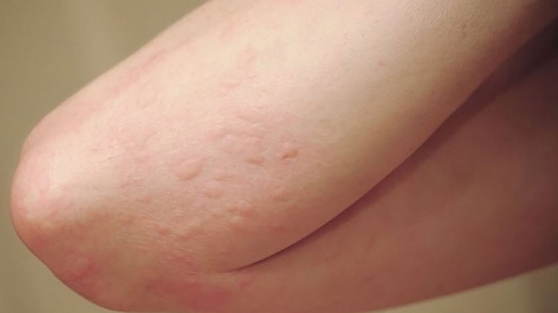 Các tác nhân khiến cho da bị ngứa gãi nổi hột 1