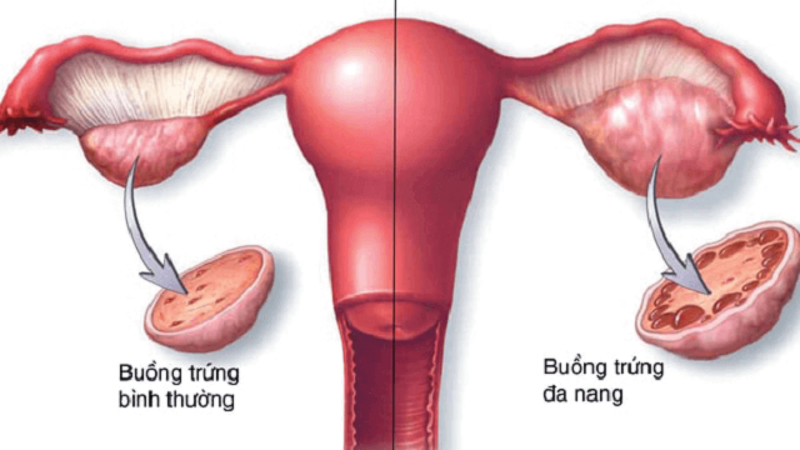 Mách bạn cách chữa chứng rậm lông ở phụ nữ hiệu quả 1