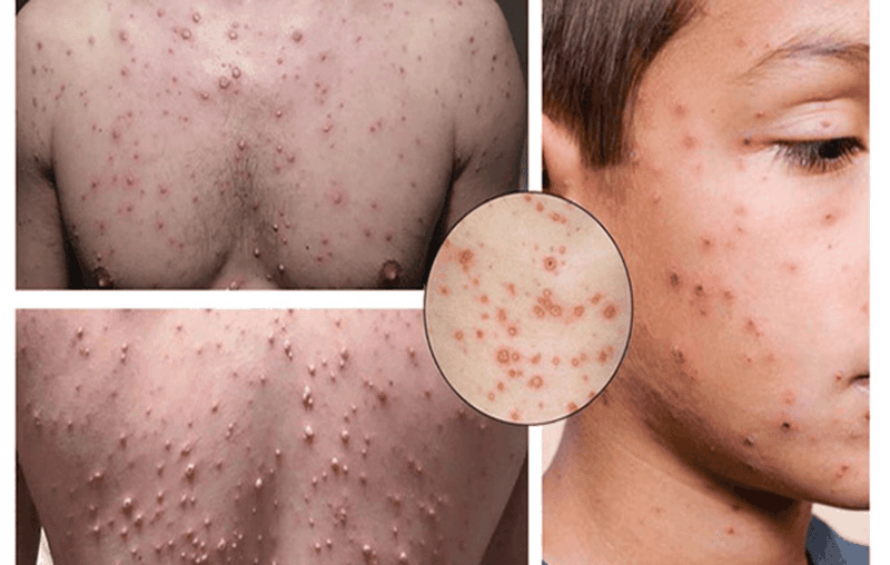 Cach-chua-thuy-dau-o-nguoi-lon-nhanh-nhat-la-gi 3.png