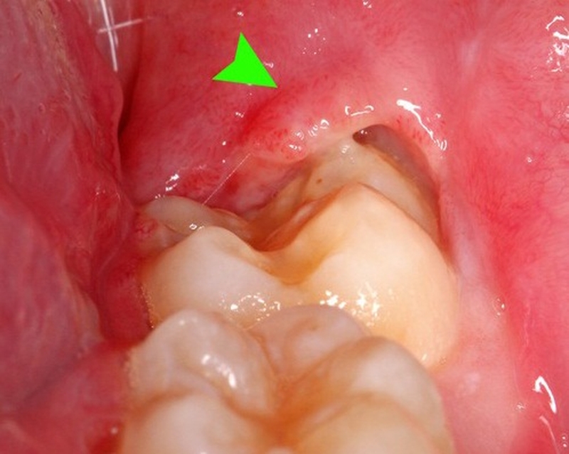 Cách chữa viêm lợi cho bà bầu không gây tác dụng phụ 2