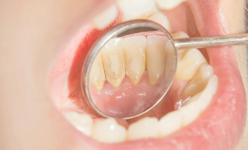 Cách khắc phục khi lấy cao răng xong bị chảy máu liên tục 1