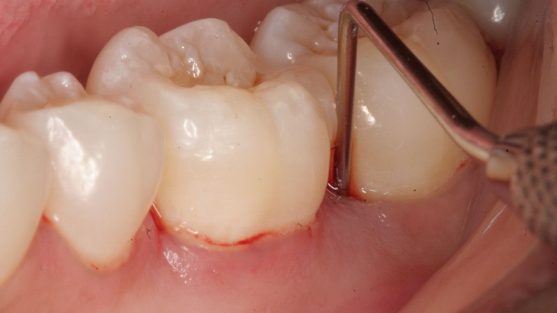 Cách khắc phục khi lấy cao răng xong bị chảy máu liên tục 2