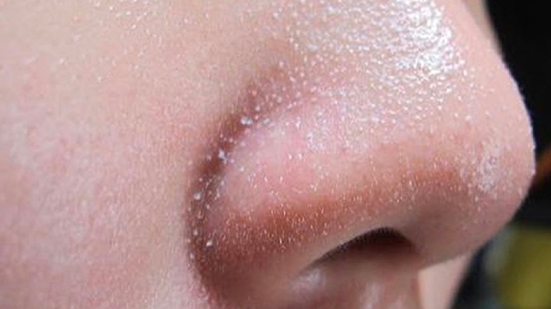 Cách lột mụn cám tại nhà dễ đến không ngờ 1