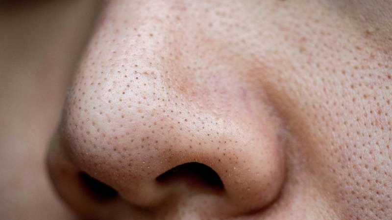 Cách lột mụn đầu đen bằng kem đánh răng cực đơn giản 3