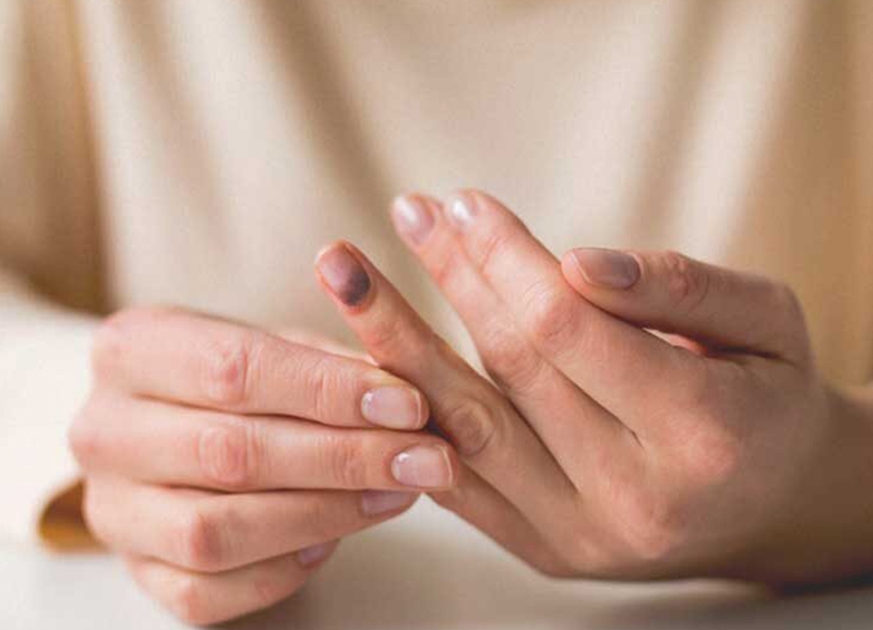 Cách sơ cứu dập móng tay hiệu quả 2