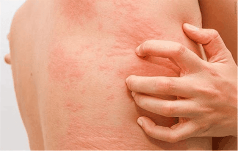 Cách xử lý khi bị dị ứng sữa tắm 4.png