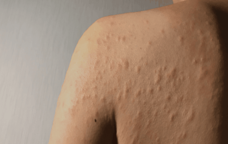 Cách xử trí khi bị dị ứng nước hồ bơi 2.png